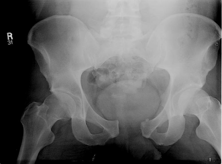Pelvic fractures Dr