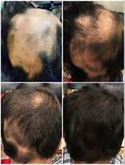 totalis/universalis, shorter duration of hair loss better Recommendations