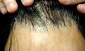 04) Patchy alopecia areata Topical clobetasol foam BID for 5 day per week