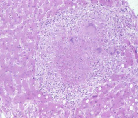 GRANULOMA FORMATION Latent Tuberculosis Infection 1) Bacteria are dormant (metabolically inactive). They later start to divide for reasons that are not clear.
