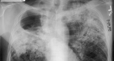Pathogenesis of Pulmonary Acquired Tuberculosis Post-Primary Disease Inhalation of Droplet