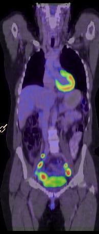 Cervical cancer - pelvic & paraaortic LN