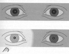 Pretectum & Pupillary Light Reflex The pretectum bilateral projections to the Edinger-Westphal nuclei ensure that both eyes react to light: shining a light into each eye can elicit a direct and a