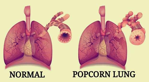 Popcorn Lung Popcorn lung is a serious lung disease linked