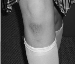 Abrasions/ecchymosis @ tibial tubercle suspect