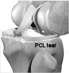 If synovial sheath intact the healing PCL contracts laxity can improve