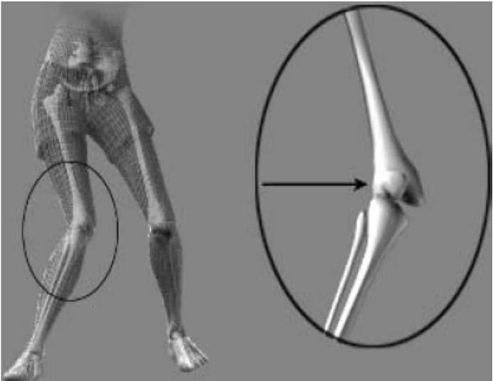 Bad Knee Mechanics Prospective Knee valgus loading predicts ACL injury risk in females ACL