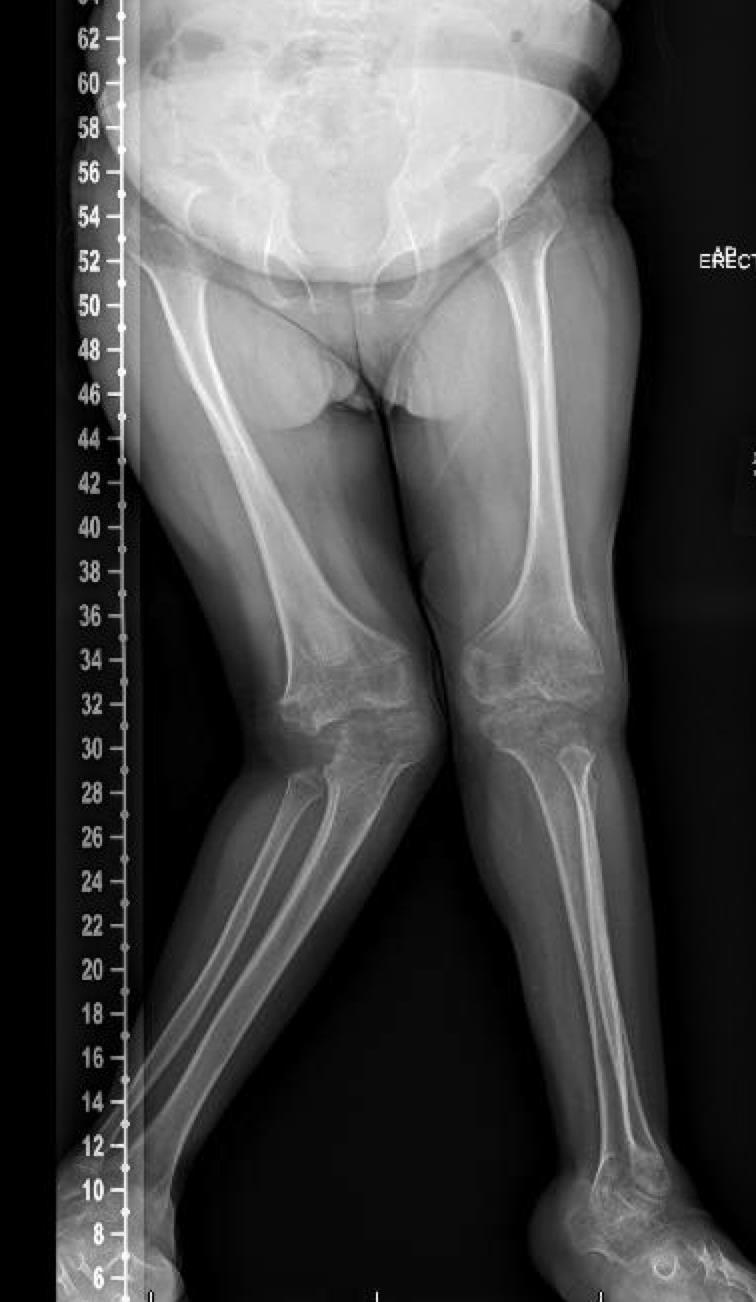 Genu Valgum Differential diagnosis: Exaggerated Physiologic Physeal/metaphyseal injuries Abnormal bones
