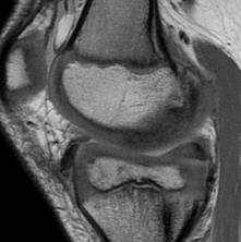 thick Central medial - thin Increased joint space Medial Meniscus