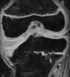 MRI Findings Other findings: Lateral