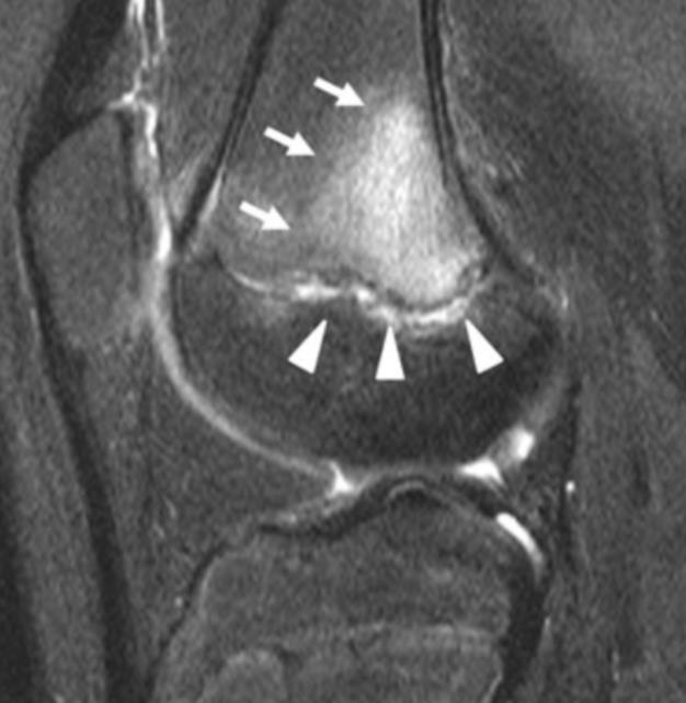 MRI Findings Other findings: Lateral proximal tibia Physis Metaphysis
