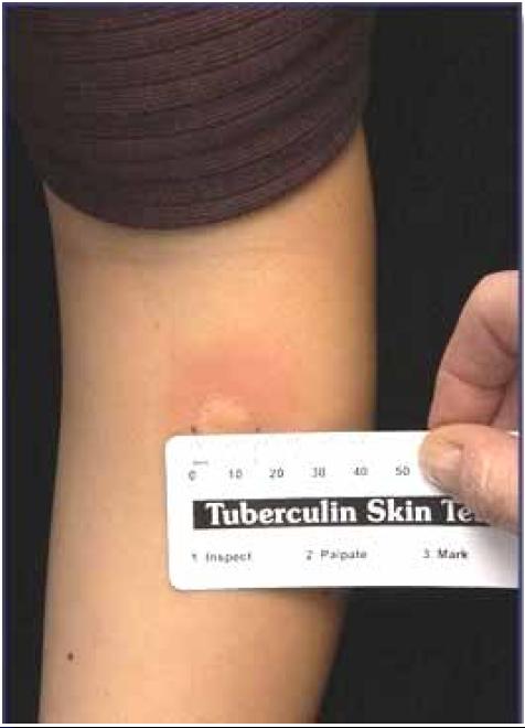 Reading the TST Measure reaction in 48 to 72 hours Measure induration, not erythema Record reaction in millimeters, not as negative or positive Positive reactions can be read for up to 7 days