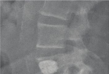 Spine metastases: are minimally invasive surgical techniques living up to the hype? Management Perspective prompt treatment to prevent dreaded sequelae.