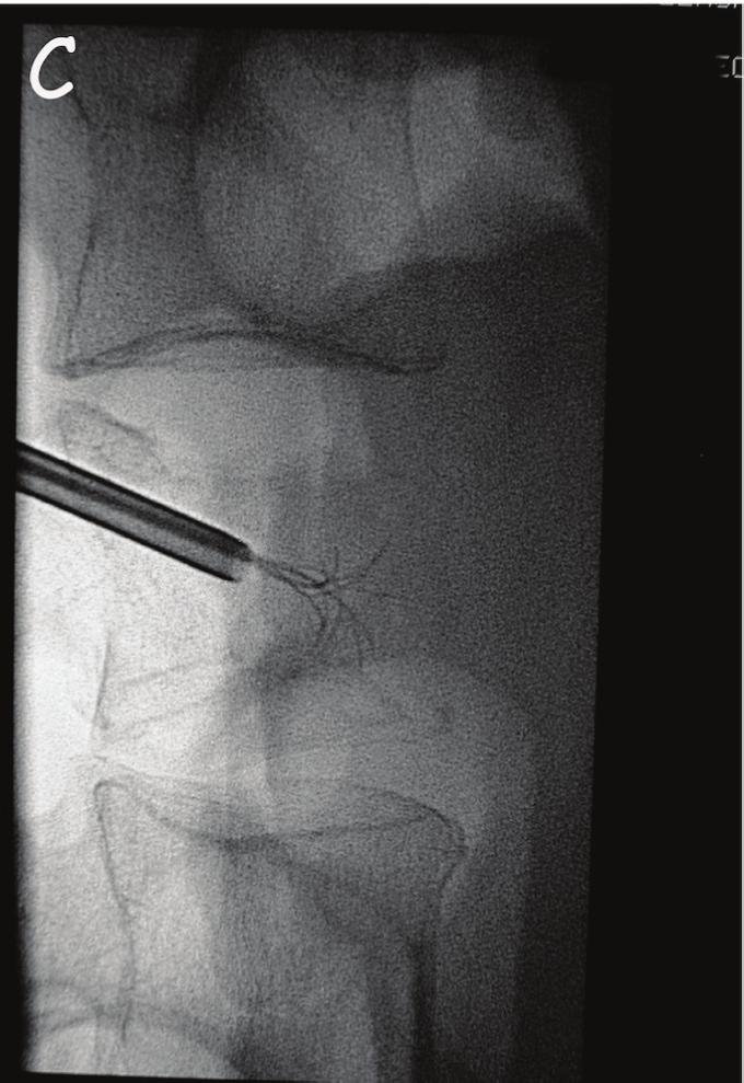 The wire is placed percutaneously into the lesion though the pedicle (B). The probe is inserted and deployed (C).