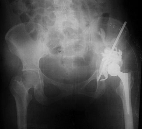 1A: Left hip radiograph of a multiple myeloma patient showing class