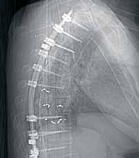 Spinal Hardware No Problem for CBCT Many patients with spine metastases have been implanted with titanium instrumentation or methylmethacrylate to support vertebrae weakened by their disease. Dr.