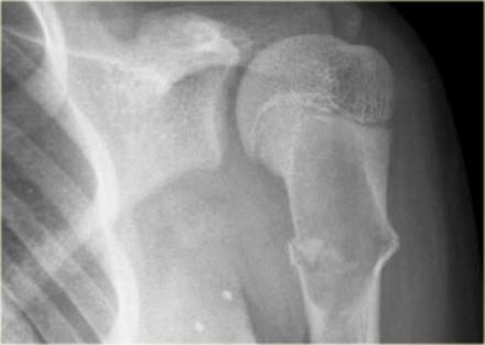 ABC can occur almost anywhere in the skeleton. ABC of the proximal fibula: well-defined, expansile osteolytic lesion with thin peripheral bone shell Discriminators: Must be under age 30.