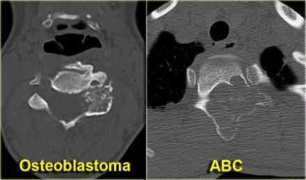 Osteoblastoma Osteoblastoma is a rare solitary, benign tumor that produces osteoid and bone. Consider osteoblastoma when ABC is in the differential diagnosis of a spine lesion (figure).