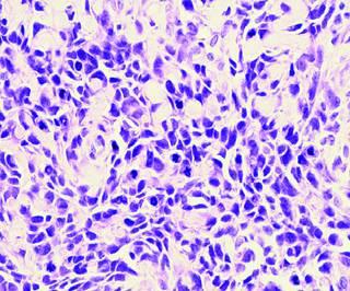 Fibrous tumor fibrosarcoma BioMolecular Markers are redefining the