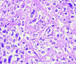 EWS round cell is Ewing s Sarcoma Initially starting as a chance