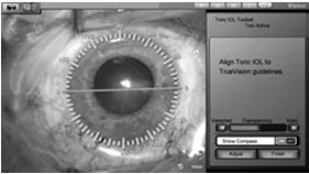 methods of visualization Visualization Method # of Eyes Unplanned Vitrectomy TrueVision 3D 293 1 (0.35%) Microscope Oculars 461 5 ( 1.