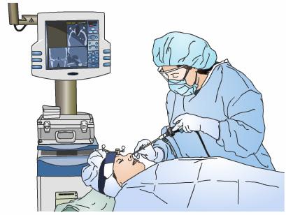 At times, your surgeon may use a sophisticated computer to help her or him navigate safely through the sinuses.