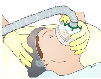 The surgeon inserts the endoscope through a tiny incision. The endoscope allows the doctor to see the sinuses on a video screen.