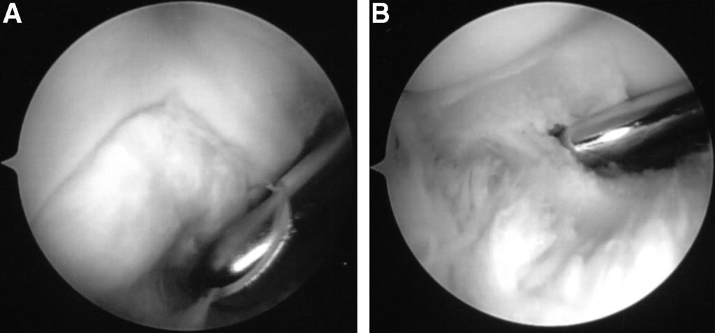 336 PEDEN AND SAVOIE FIG. 8. (A) The coronoid may be deformed in arthritic conditions resulting in impingement as seen in this arthroscopic image.