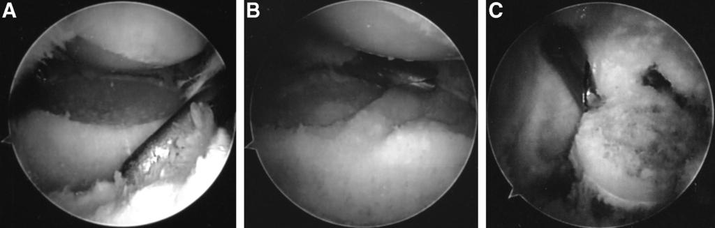 Excision of lateral gutter adhesions continues from proximally to distally and can be facilitated with debridement of the posterior radiocapitellar recess through a direct lateral portal (Fig. 7).