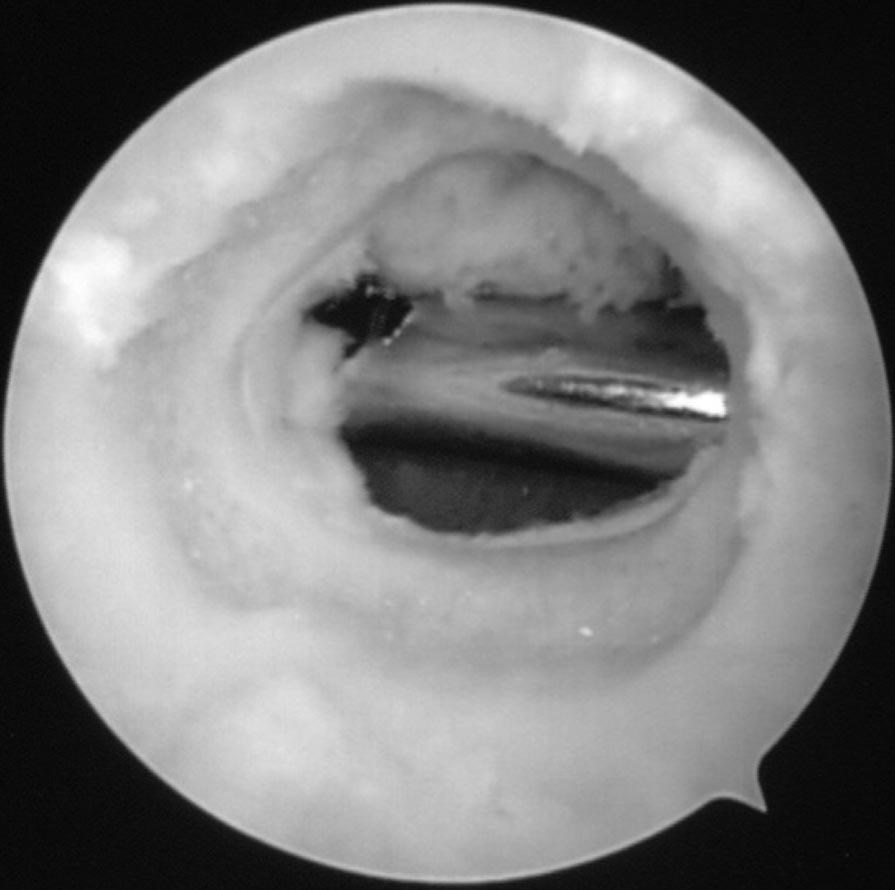 ARTHROSCOPY OF THE STIFF ELBOW 337 rheumatologic or traumatic elbow with an incompetent medial collateral ligament. Several techniques allow arthroscopic radial head excision to be safely performed.