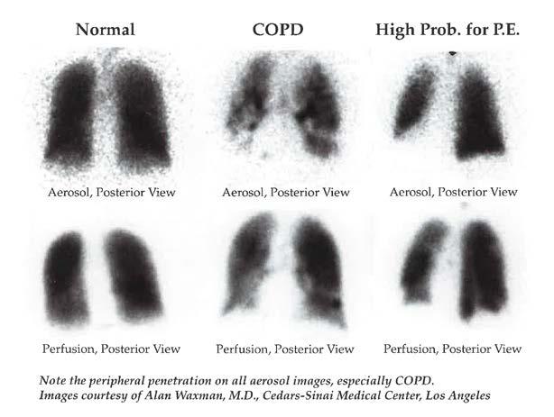 Ventilation-Perfusion Scans Demonstrates contribution of lobes/segments to ventilation and