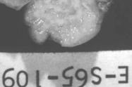 unusual) Alveolar adenoma (rare) Hamartoma Likely a misnomer as these are probably true