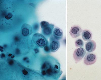 Interpretation: ASC-H versus HSIL Cytomorphologic Criteria: Metaplastic cells with
