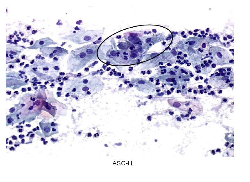 Few squamous cells suggestive of a high-grade lesion