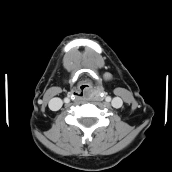 Figure 2. Enhanced CT scan (venous phase) showed a nodule protruding into the laryngeal cavity.
