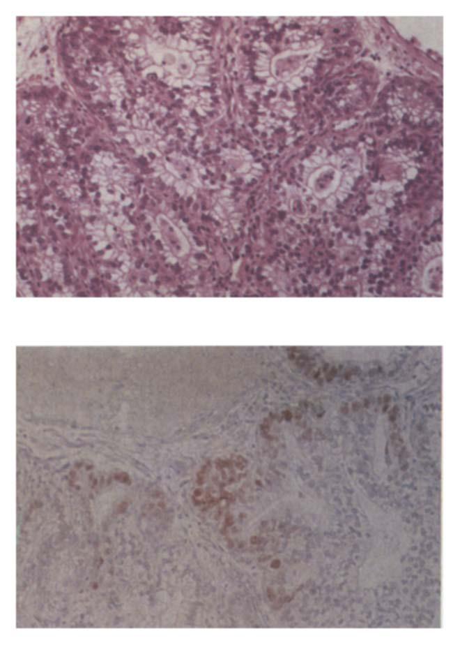 1 1 3 4 Rice et al. The Journal of Thoracic and December 1994 Fig. 3. Top, Section of Barrett's esophagus with high-grade dysplasia, stained with hematoxylin and eosin.