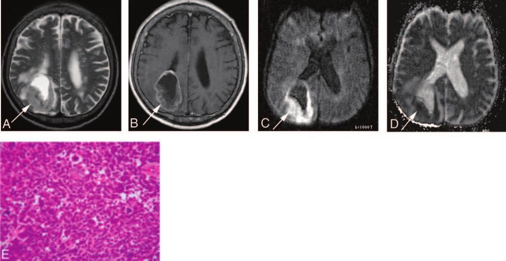 Fig 4. A 69-year-old man with small-cell carcinoma from the lung.
