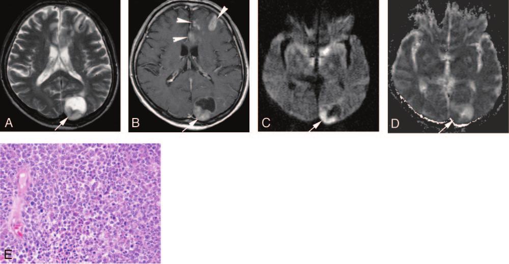 B, On contract-enhanced T1-weighted image, the peripheral region of the lesion is enhanced (arrow). C, On DWI, the lesion is hyperintense relative to the normal-appearing cortical gray matter (arrow).