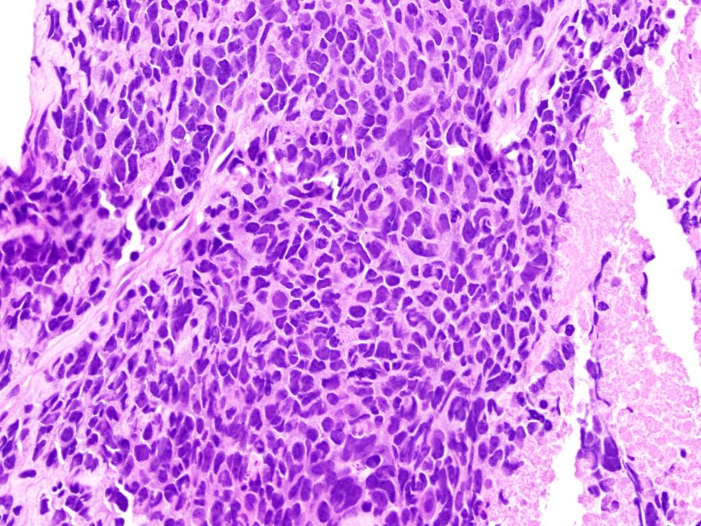 Small Cell Carcinoma Small cell carcinoma of the prostate is not assigned a