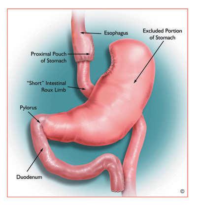 Current Most-Used Bariatric Procedures Roux-en-Y GB Gastric Banding % Complications 1 9 8 7 6 5 4 1 Splenectomy.4 Laparoscopic vs. Open Gastric Bypass Complications Review of 464 cases 1.