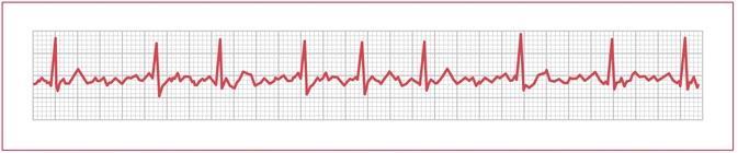 16. The ECG below represents. a. atrial fibrillation b. digoxin toxicity c. normal sinus rhythm d. previous infarction Questions 17 20: Factors Affecting ECG Trace Quality 17.