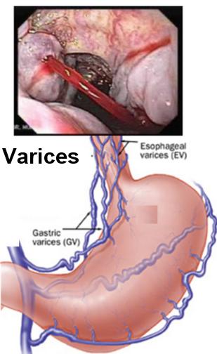 Cirrhosis Complications Center Around Increased Portal Vein Blood Pressure Encephalopathy Shunting Hepatic Insufficiency Increased Resistance Portal