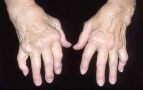 ACUPUNCTURE FOR ARTHRITIS 风湿病 Rheumatoid arthritis is an inflammatory disorder.