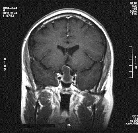 ) Imaging results: MRI reveals a large sellar mass abutting the optic chiasm and cavernous sinus invasion Invasion of the tumor into the cavernous sinus