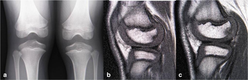 Kanto et al. Journal of Medical Case Reports (2016) 10:3 Page 3 of 6 Fig. 1 Image examinations at initial visit. a A posterior-anterior weight-bearing radiograph (Rosenberg s view) at initial visit.