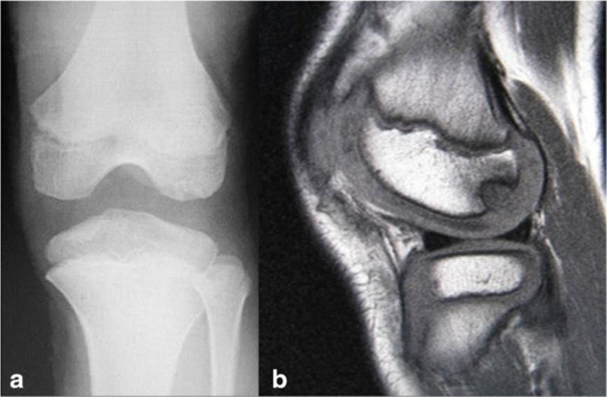 An area of low signal intensity at the periphery of subchondral bone contour is present in the lateral femoral condyles of the patient s right (b) and left (c) knees (8 mm in diameter) was performed