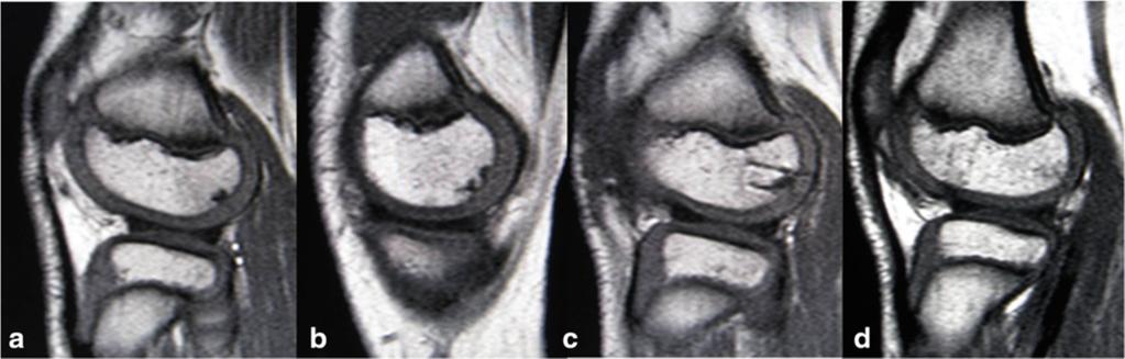 lesions in both knees Fig. 3 Fluoroscopic view during transplantation of the osteochondral graft with complete healing of the subchondral bone lesion in the radiograph (Fig. 5).