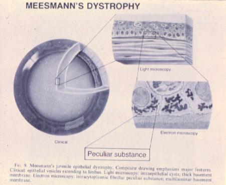 Meesman s Juvenile Dystrophy (Stocker-Holt) Etiology: Rare, inherited autosomal dominant trait,
