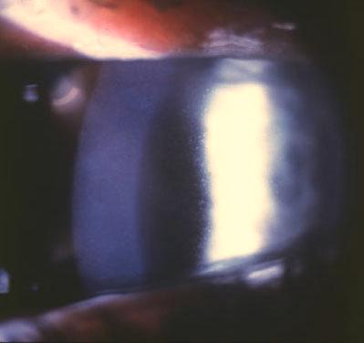 Slit lamp: multiple, small gray-white punctate opacities (cysts or vesicles) in the