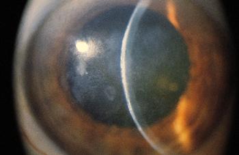 , recurrent erosions, conjunctival injection, and gradual opacification cause